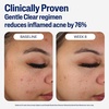 Cetaphil Gentle Clear BPO Acne Face Wash, Soothing, Sensitive Skin, 4.2oz(3 Fl Oz (Pack of 12))